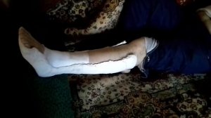 Реабилитация после перелома лодыжки