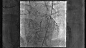 Как делают стентирование сосудов сердца