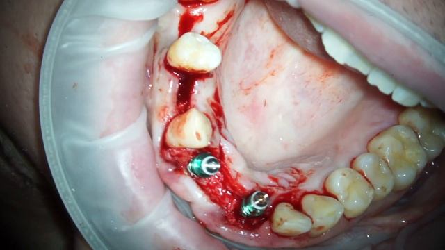 Одномоментная имплантация передних зубов с костной пластикой смотреть онлайн