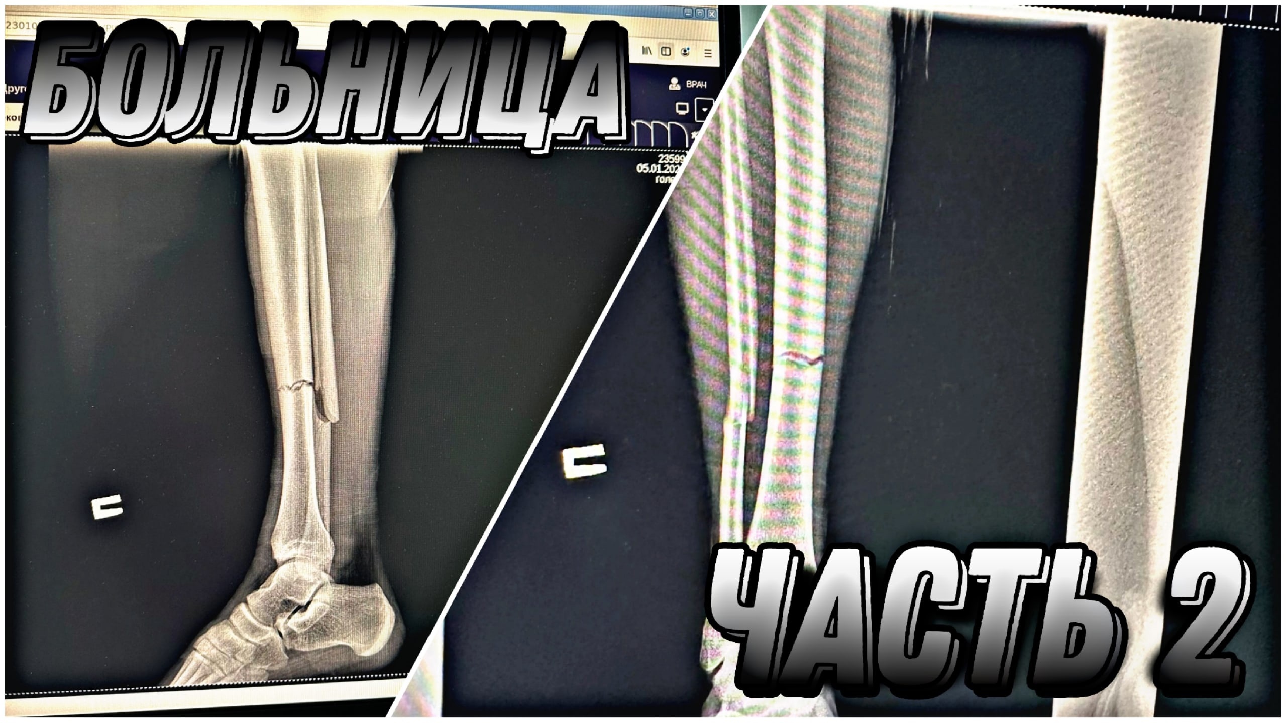 Что было в БОЛЬНИЦЕ!?||ПЕРЕЛОМ?\\ОПЕРАЦИЯ? смотреть онлайн