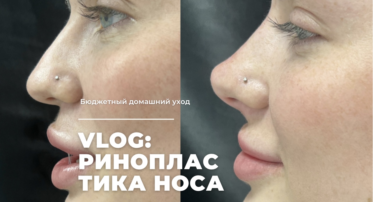 VLOG: РИНОПЛАСТИКА НОСА