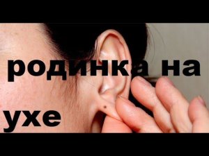 РОДИНКА НА ЗАТЫЛКЕ И РОДИНКИ НА УХЕ.