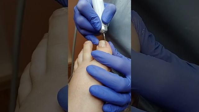 Аппаратный медицинский педикюр. Работа на аппарате со спреем. смотреть онлайн