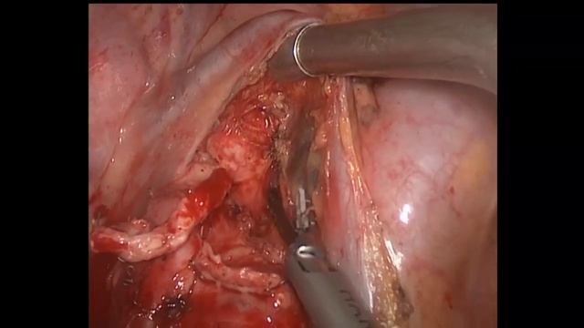 Asvide: Lymph node dissection (2R, 4R) смотреть онлайн