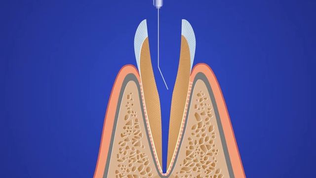 Периодонтит смотреть онлайн