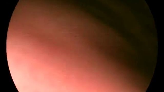 Гастроскопия с помощью видеоэндоскопической системы VME смотреть онлайн