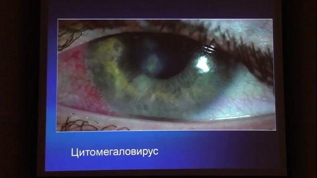 Аденовирусные конъюктивиты - основные ошибки при диагностике и терапии смотреть онлайн