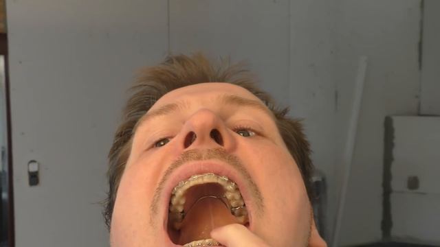 1½ Year with Braces, and approaching the END - 364 смотреть онлайн