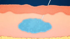 Что такое инъекции гиалуроновой кислоты?