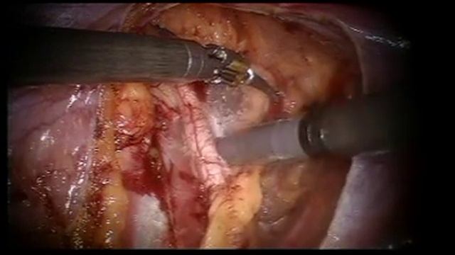 Robotic Left pelvic node sampling смотреть онлайн