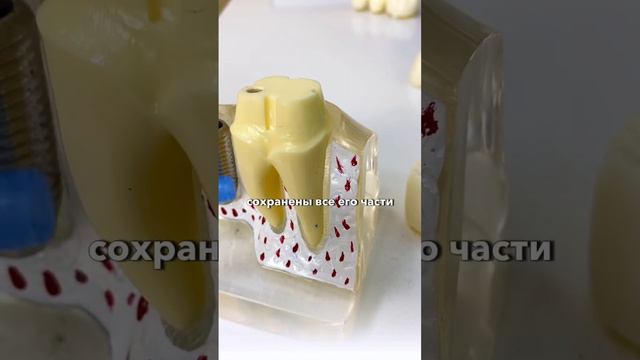 Если у Вас сильно разрушен зуб, не всегда можно поставить пломбу ☝🏻#имплантациязубов смотреть онлайн