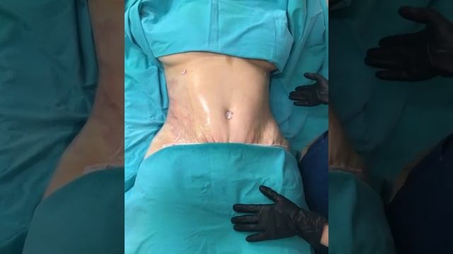 Круговая липосакция с абдоминопластикой 2