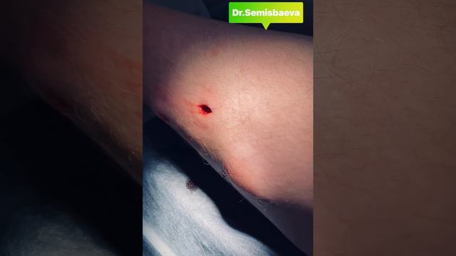 Удаление жирового образования (липомы) смотреть онлайн