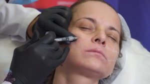 Коррекция скуловой зоны дермальным филлером GENYAL Volumae Швейцария