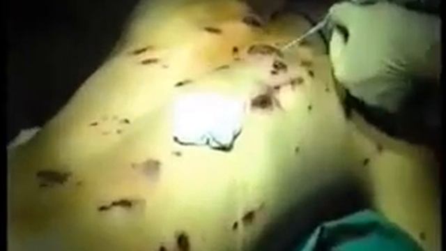 Осколочная рана спины Fragmental wound of a back смотреть онлайн