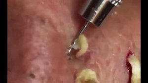 removal of acne.удаление акне