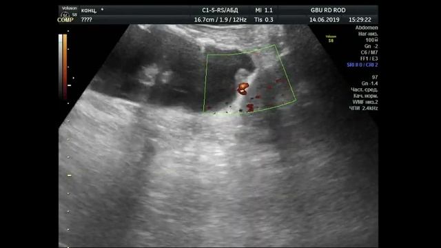 Канцероматоз брюшины . Рецидив рака яичника.