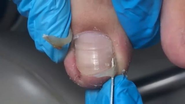Big problem with the front of the toenail! Trim carefully【Crazy pedicure room】 смотреть онлайн