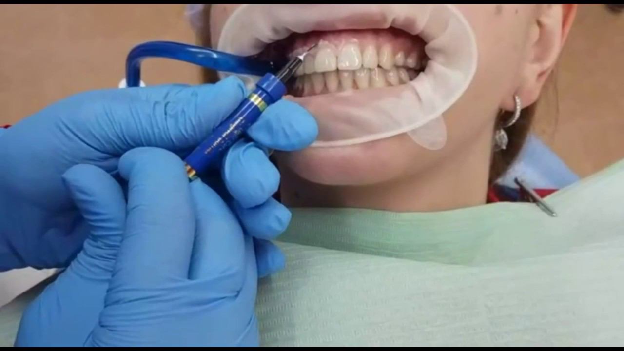 Аппаратное отбеливание зубов amazing white смотреть онлайн