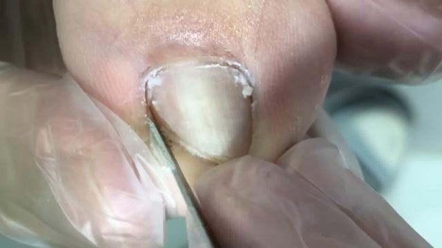 Huge Inset Armor! Relieve Foot Discomfort【Crazy Pedicure Room】