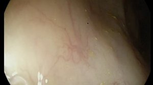 Глисты разъедают нас изнутри. Видео как гуляют в нашем кишечнике паразиты глисты -острицы. #shorts