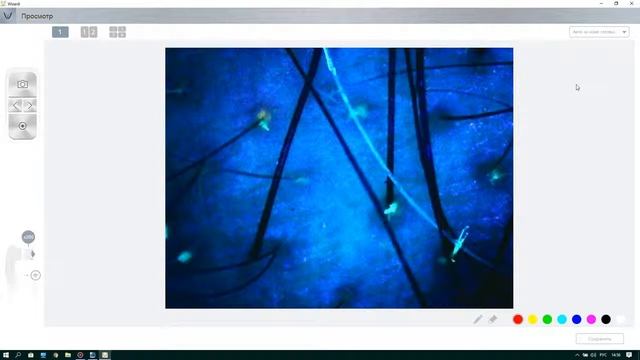 Трихоскопия   с помощью дерматоскопа трихоскопа ARAMO ASW