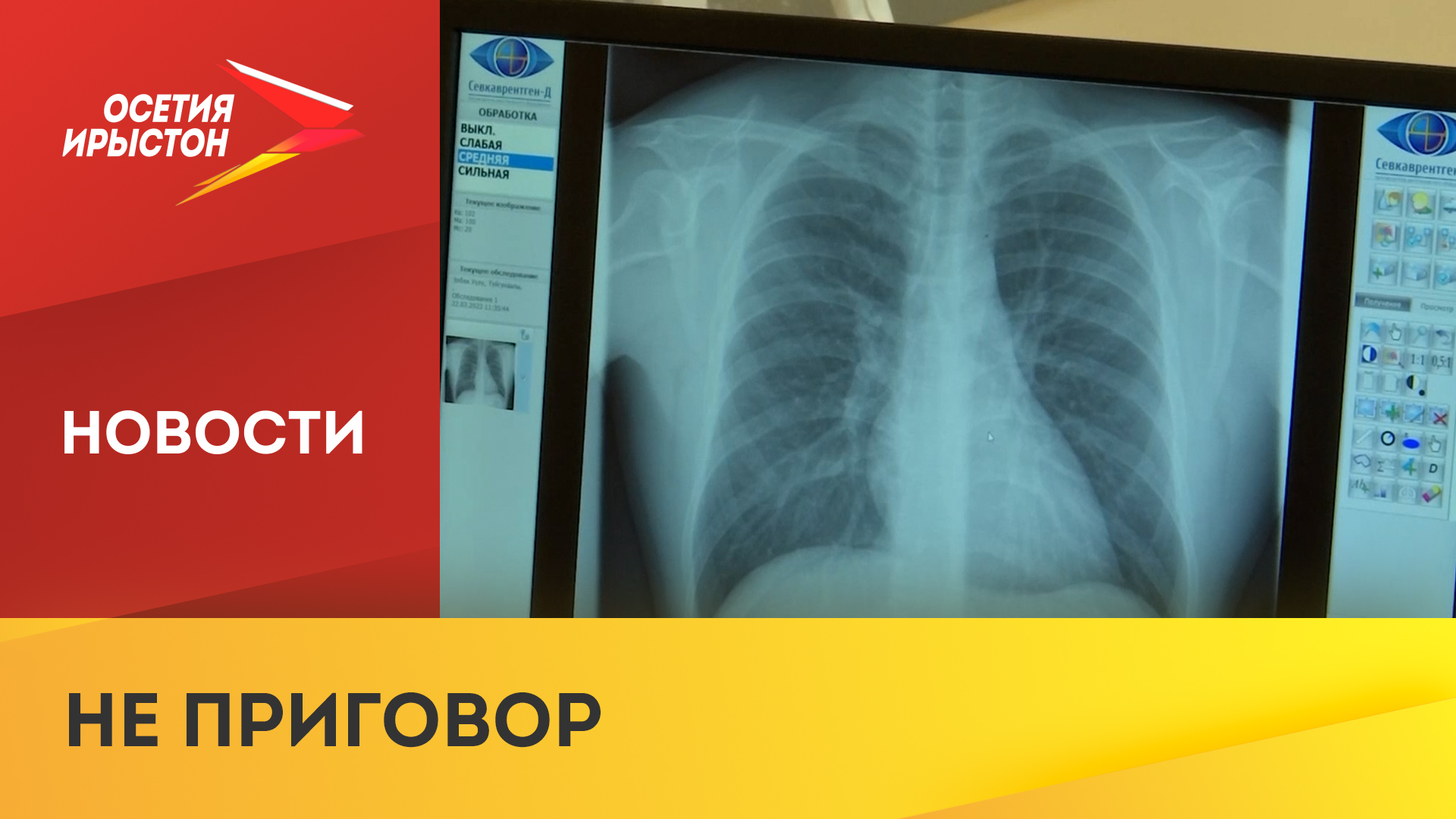 24 марта - всемирный День борьбы с туберкулёзом смотреть онлайн