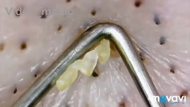 NEW Pimple Popping Compilation 2019 #2 смотреть онлайн