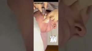 липоредукция 1