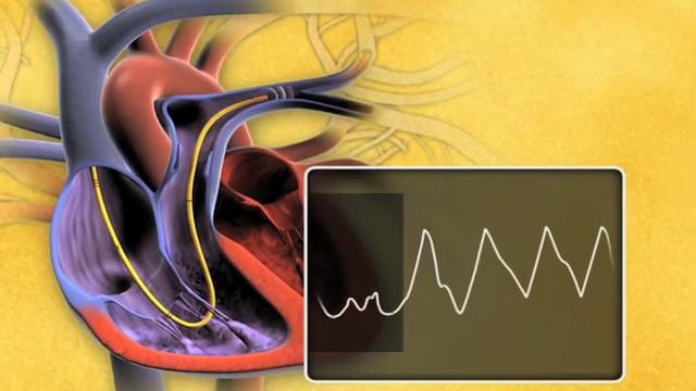 Swan-Ganz Thermodilution Pulmonary Artery Catheter