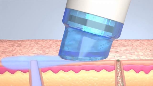 Аппаратная чистка лица - HydraFacial MD