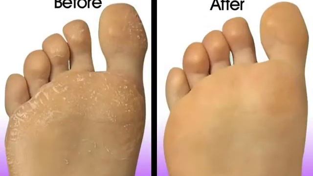 Ped Egg National Infomercial смотреть онлайн