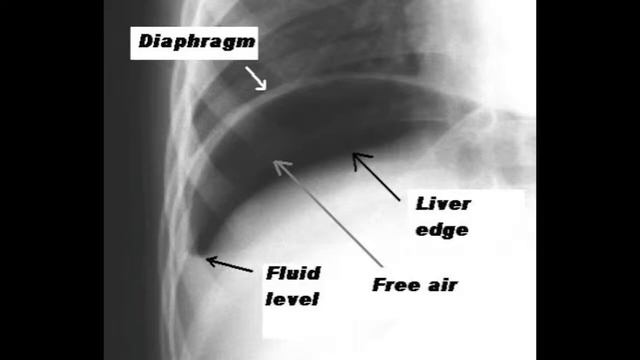 Extrapulmonary pathology final смотреть онлайн