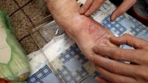 Перевязка трофических язв ветерану ВОВ на дому своими руками из того, что есть