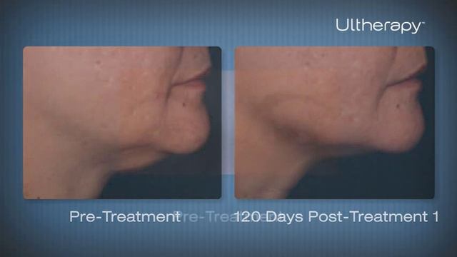 Ulthera® by Wave Plastic Surgery & Aesthetic Laser Center смотреть онлайн