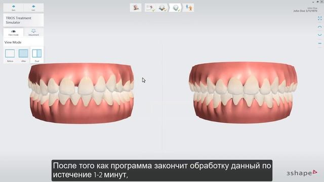 3shape TRIOS - Treatment Simulator алгоритм работы - Workflow смотреть онлайн