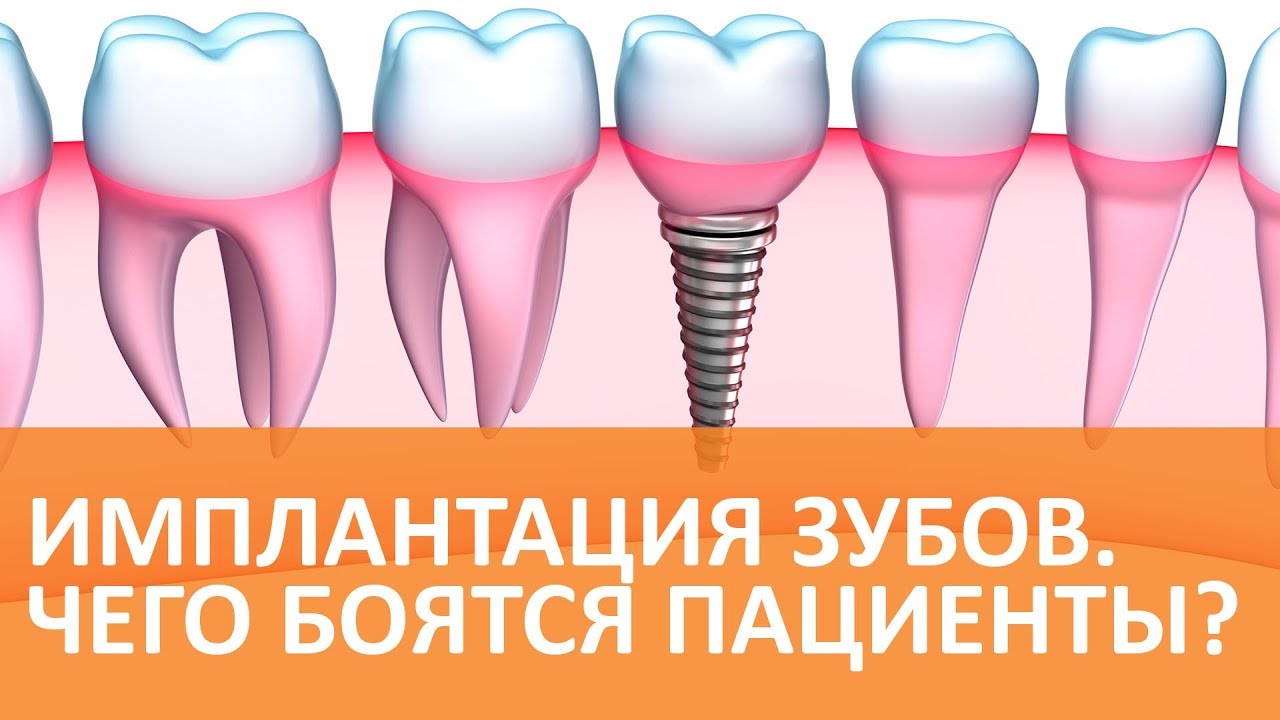 Имплантация зубов - вопросы стоматологу–хирургу смотреть онлайн