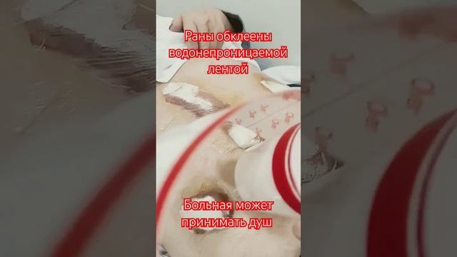 Раны обклеены водонепроницаемой лентой, пациент может принимать душ смотреть онлайн