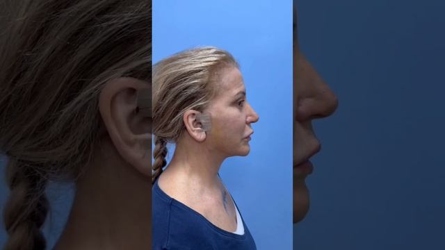Подтяжка лица и шеи, верхняя блефаропластика и риносептопластика смотреть онлайн
