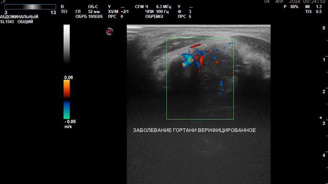 Рак гортани верифицированный, режим ЦДК смотреть онлайн