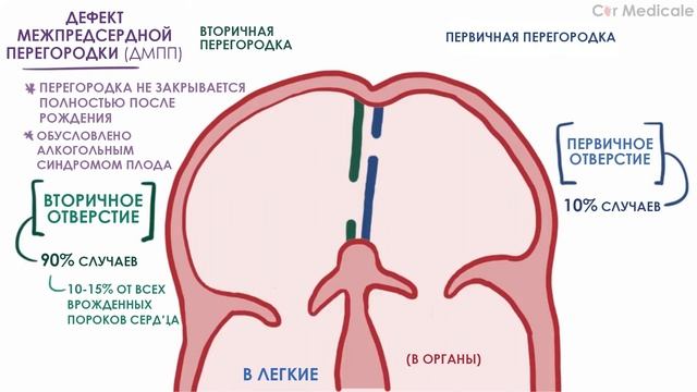 Дефект межпредсердной перегородки: что такое, механизм развития, симптомы и осложнения - кратко смотреть онлайн
