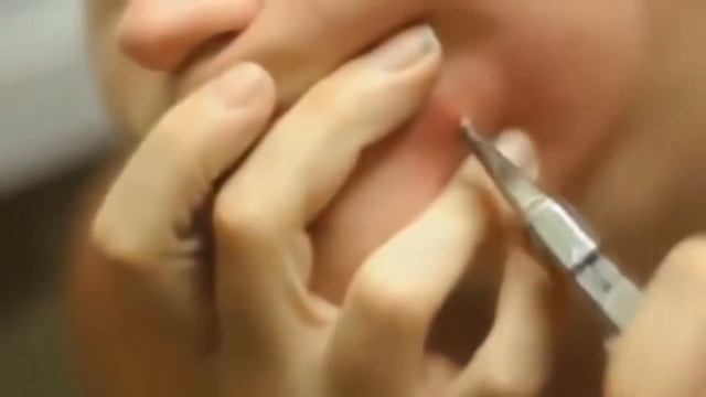 ОГРОМНЫЙ ЧИРИЙ НА ЛИЦЕ. УДАЛЕНИЕ (МНОГО ГНОЯ)