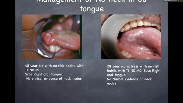 Principles of NecK node Dissection смотреть онлайн