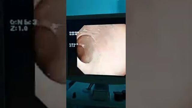 Постъязвенная деформация луковицы 12-ти перстной кишки, псевдодивертикул. Сливовая кость застряла. смотреть онлайн