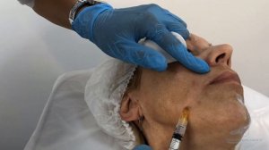 Омоложение жидкими нитями Vitten Elastine, канюльная техника.