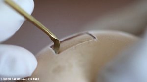 DASK - Dentium Advanced Sinus Kit (tutorial)