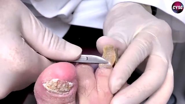 Pedicure Hoof Trimming // Обрезка Шлифовка Толстых Ногтей