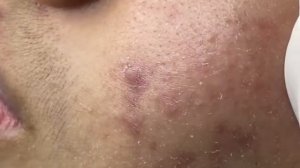Remoção de cravo 2021 - Pimple Popping 2021 -Blackhead Removal  EP0020