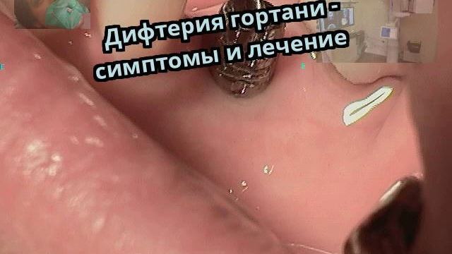 Дифтерия гортани - симптомы и лечение смотреть онлайн