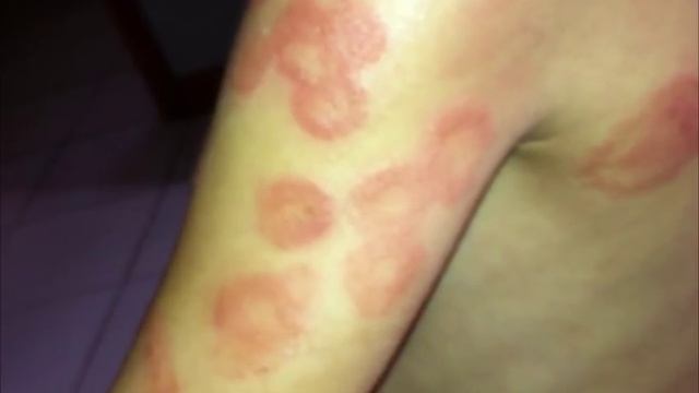 8 Ways to Get Rid of Eczema смотреть онлайн